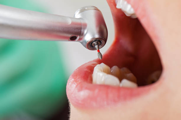Best Urgent Care for Lost Fillings or Crowns in St Helena, CA